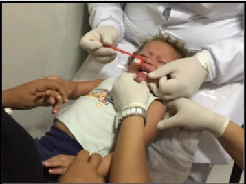 Figura 2. GRUPO II – Crianças que abandonaram o Programa “Boquinha do bebê”, em  que a mãe realiza higiene bucal quando a criança deixa