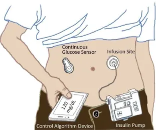 Figure 1: Mono-hormonal artificial pancreas. A bihormonal artificial pancreas should yet add a pump for the hormone glucagon