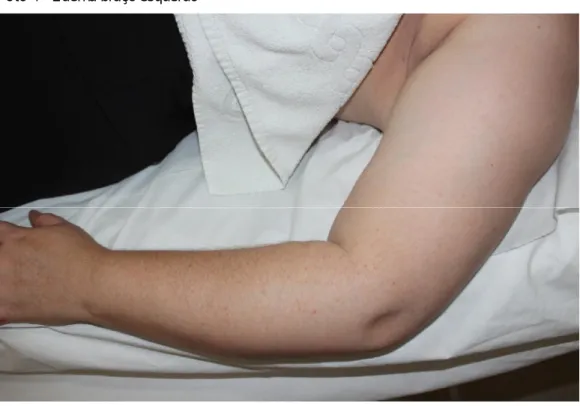 Foto 4 - Edema braço esquerdo 