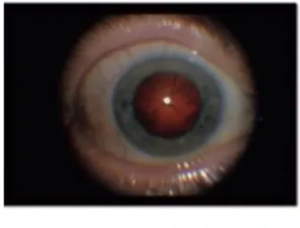 Figure 5- l’œil dilaté  