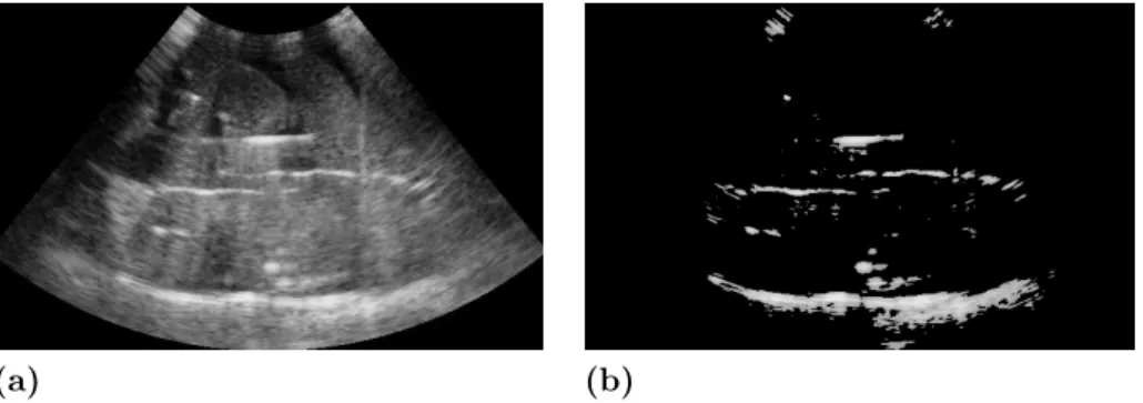 Figure 1.15 – Needle detection using the RANSAC algorithm. (a) Ultrasound image. (b) Candidate set obtained by thresholding.