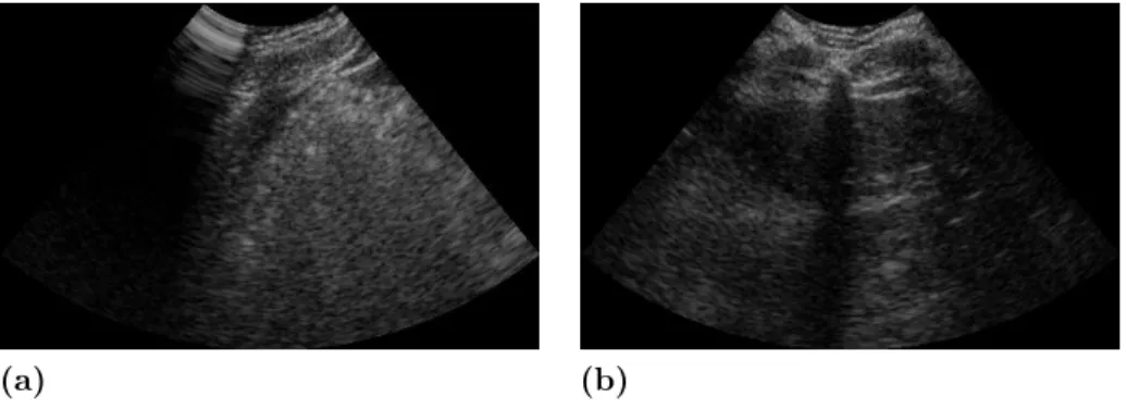 Figure 1.19 – Ultrasound images of a human abdomen showing (a) a drop-out artifact on the left, and (b) a local acoustic shadow in the center.