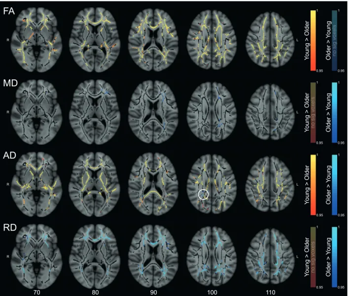 Figure 2.1 – White matter differences between young and older participants. This figure shows thresholded significant  voxels (1-p &gt; 0.95 corrected) overlaid on group-specific white matter skeleton in dark gray and standard MNI152  template
