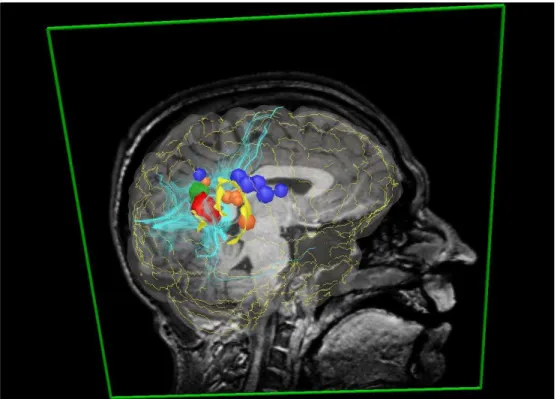 Fig. 1.5 – Sc`ene multimodale du patient. Les cibles, en rouge et en vert, sont les l´esions obtenues par IRM