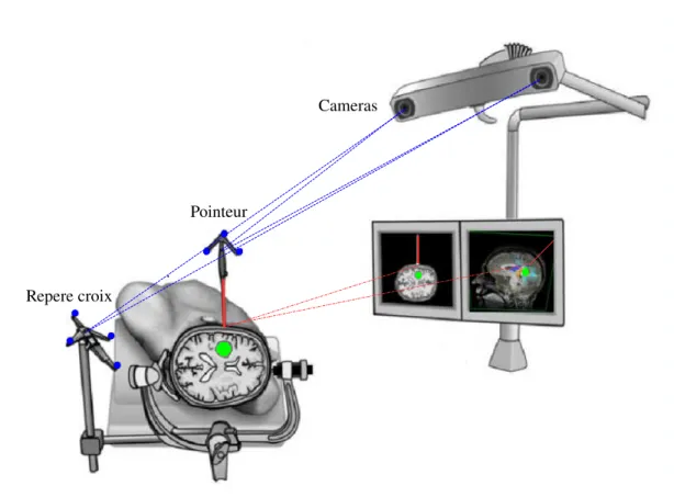 Fig. 1.7 – Principe de la neuronavigation. Apr`es une ´etape de recalage patient-image, le rep`ere du patient (rep`ere croix) et le rep`ere des images pr´eop´eratoires sont mis en correspondance