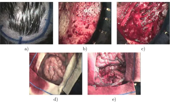 Fig. 1.8 – Les diff´erentes ´etapes de la craniotomie. a) Le neurochirurgien d´efinit la position de la craniotomie grˆace au syst`eme de neuronavigation