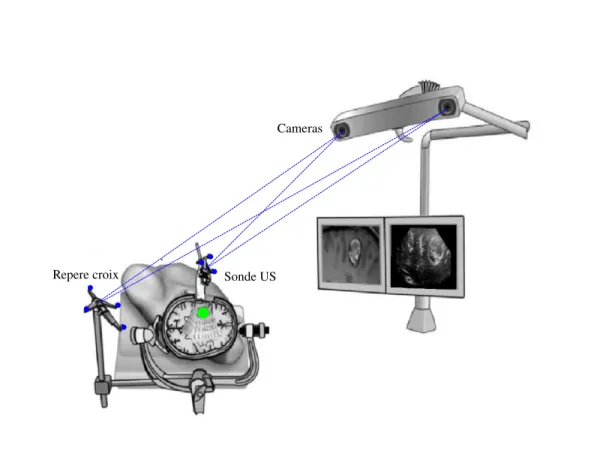 Fig. 2.3 – Principe de l’´echographie intraop´eratoire de type main libre. Le syst`eme de neuronavigation est ´equip´e de cam´eras qui calculent en continue la position et  l’orienta-tion de la sonde d’´echographie