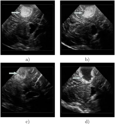 Fig. 4.4 – Exemple d’images ultrasonores intraop´eratoires prises `a chaque ´etape du protocole d’acquisition