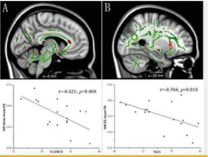 FIGURE  2: Correlation  analysis  between  fractional  anisotropy  (FA)  and  behavioral  measures  within the Internet addiction disorder (IAD) group