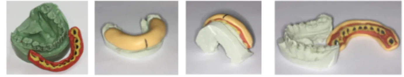 Figure 7: Left image : polymerized &#34; inner &#34; transfer tray separated from stone cast ;  other images: cold-cured acrylic  &#34; outer &#34; transfer tray on top of  &#34; inner &#34; tray