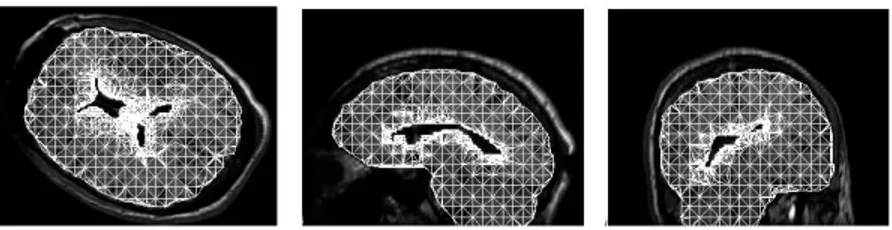 Fig. 4 – G´en´eration du maillage sur les IRM pr´eop´eratoire apr`es segmentation du cortex et des ventricules