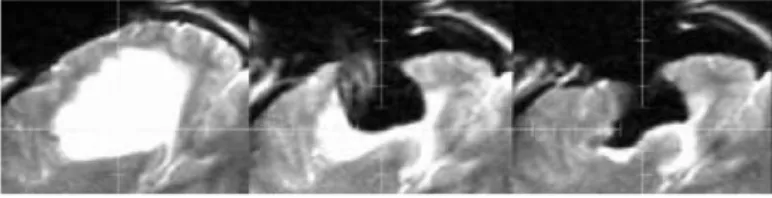 Fig. 2 – Illustration du ph´enom`ene de ”brain shift” au cours de la r´esection d’une tumeur sur des IRMi pond´er´ee en T2