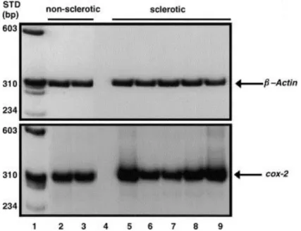 Fig. 2. Increased expression of COX-2 mRNA in the CA1 subfield of epileptic patients. Total RNA was extracted from  the CA1 regions of biopsies from five epileptic patients with hippocampal sclerosis (HS: lanes 5–9) and from two  epileptic patients without