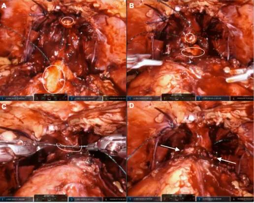 Figure 1: This illustrates 4 different stages of circular suturing in an urethrovesical 