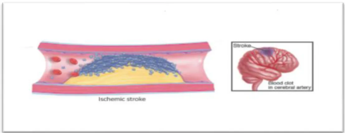 Figure 03: Ischemic stroke (Bonaca M P et al., 2014). 