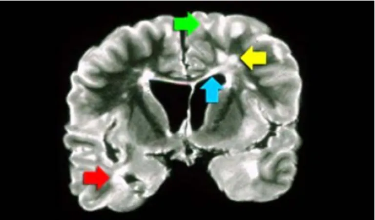 Figure 3.5: Coronal PD image of a brain specimen with MS involvement.