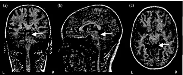 Figure 1:  Coron al  (A),  sagital (B) and axial (C) MRI showing a smalllesion in the  right inferior colliculus (arrow)