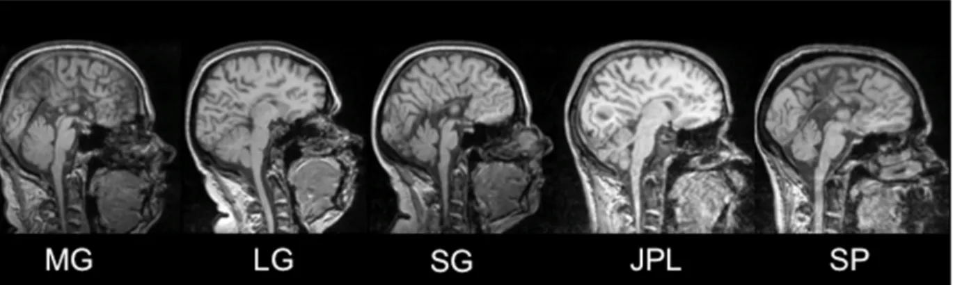 Figure 1. MRI of the five participants with AgCC in midsagital view  showing total absence of the corpus callosum