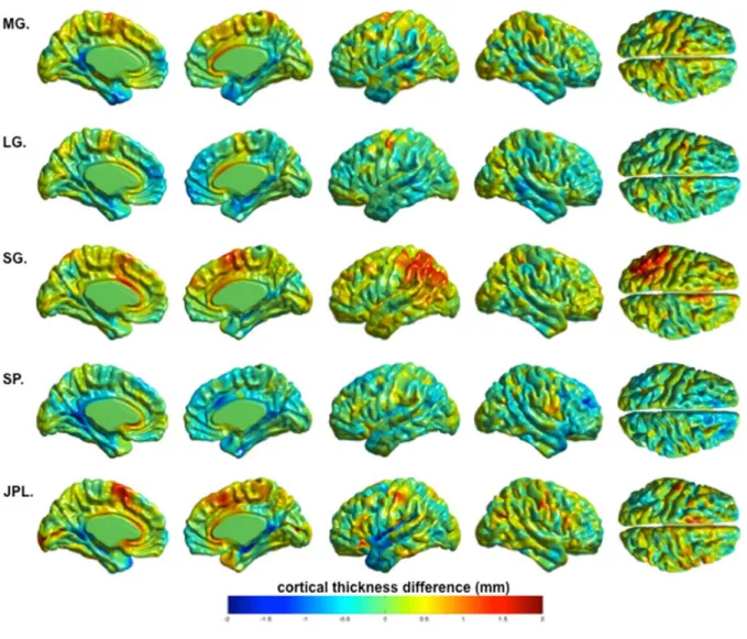 Figure 2. Cortical thickness results for the five AgCC patients, compared to  healthy controls 