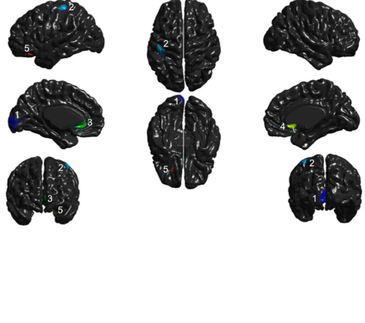 Figure 3. Conjunction analysis showing thickening or thinning of brain  areas present in all subjects, compared to controls  