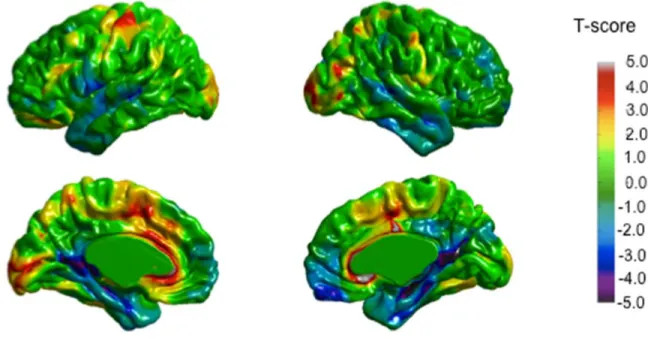 Figure 4. Whole brain analysis (t-values) of the combined AgCC patients  compared to the control group 