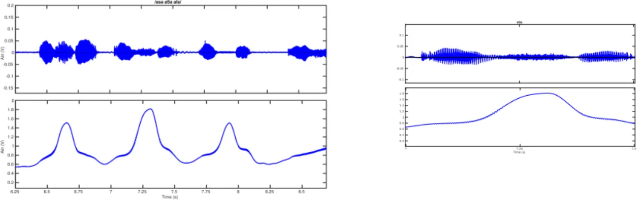 Figure 2. EPGG signal (bottom) and acoustic signal (top) for /asa aSa afa/ and zoom on /aSa/