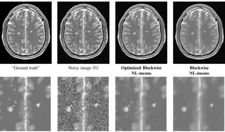 Fig. 10. Comparison of the optimized and non-optimized blockwise NL-means on T2-w images: NL-means restoration of T2-w Brainweb data with MS lesions