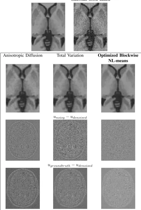 Fig. 13. Comparison with Anisotropic Diffusion, Total Variation and NL-means denoising on synthetic T1-w images