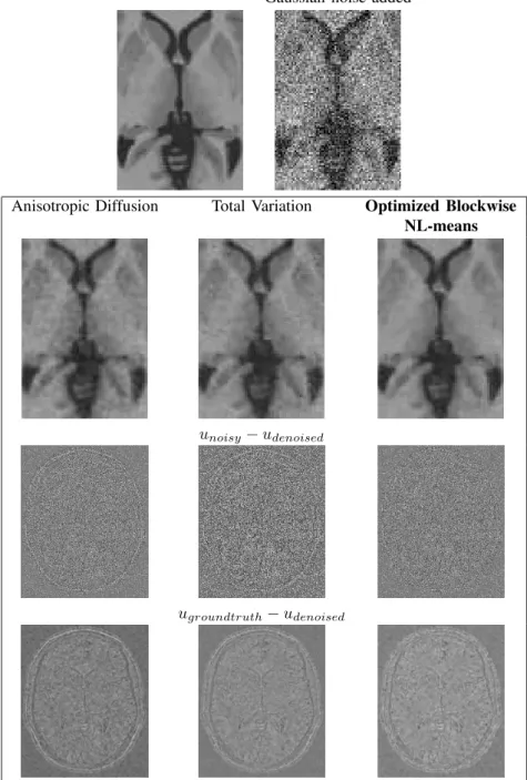 Fig. 14. Comparison with Anisotropic Diffusion, Total Variation and NL-means denoising on synthetic T1-w images