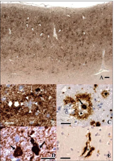 Figure 1.1 : Immunohistochimie des lésions corticales de la maladie d’Alzheimer Ces immunohistochimies ont été réalisées avec la méthode du complexe  avidine-biotine en utilisant la diamino-benzidine comme chromogène