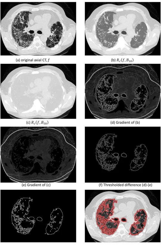 Figure 25. Example of pathological region segmentation (fibrosis) of Figure 20 (a) using morphological filters and watershed