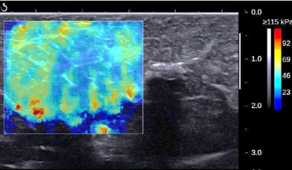 Figure 2.13: Illustration of an elasticity map obtained thanks to ultrasound elastography - -[Frauziols 15a]
