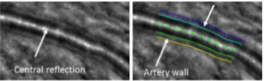 Fig. 1: Segmentation of an AOO image of a retinal artery [8].