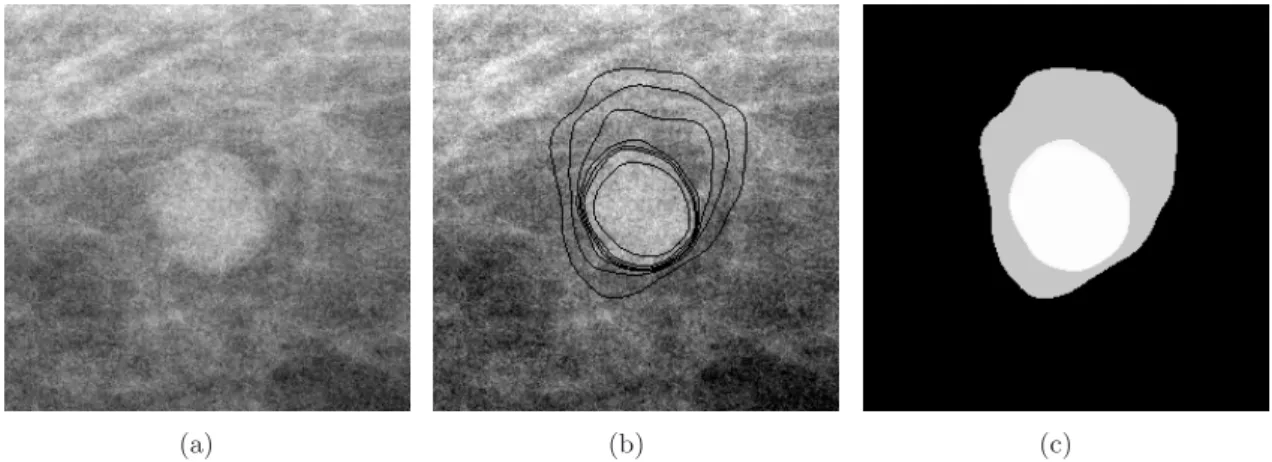 Figure 10: (a) R´egion d’int´er`et dans une projection de tomosynth`ese, (b) contours flous extraits, (c) carte de particules floues correspondante pour la d´etection d’opacit´es.