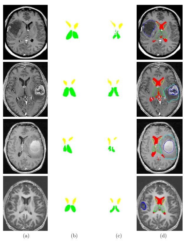 Figure 22: R´esultats de segmentation. (a) Une coupe axiale de l’image originale. (b) Segmentation manuelle