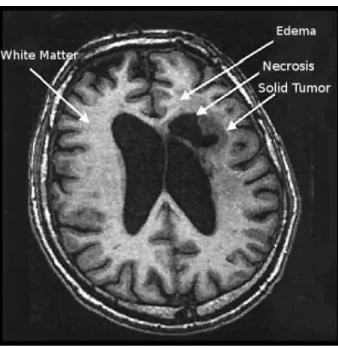 Figure 1.4: One axial slice of a MR image of the brain showing tumor areas [Mahmoud- [Mahmoud-Ghoneima et al., 2003].