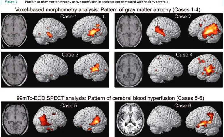 Figure 1 Pattern of gray matter atrophy or hypoperfusion in each patient compared with healthy controls