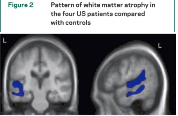 Figure 2 Pattern of white matter atrophy in the four US patients compared with controls