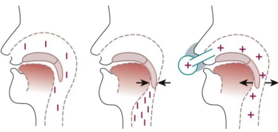 Figure 5. Mechanism of upper airway occlusion and its prevention by nasal continuous  positive airway pressure (CPAP)