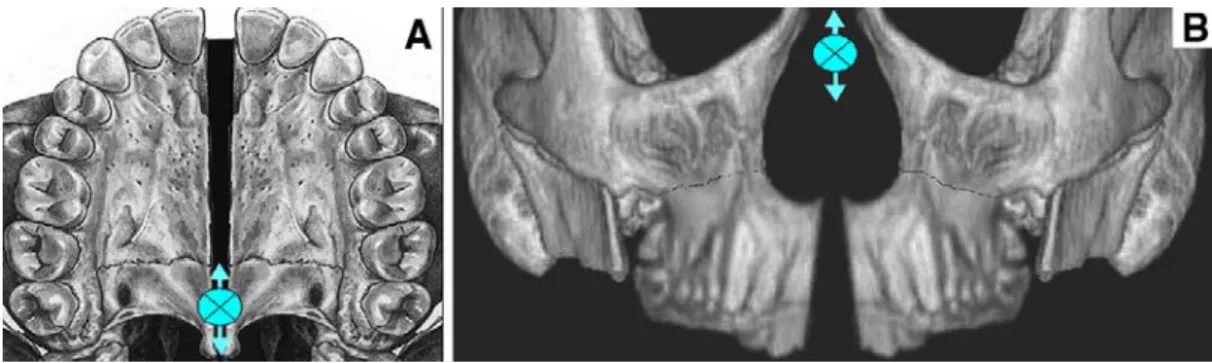 Figure 6. Sutural opening after RPE. A, horizontal view: V-shaped opening of palatum  durum after RME, with the rotational center near the third molar; B, Frontal view: V-shaped  rotation of the maxilla after RME with the rotational center near the fronton