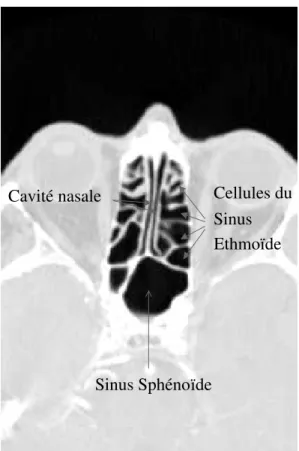 Fig. 1.6 : Exemple de clich´e TDM axial, acquis au niveau du sinus ethmo¨ıde.