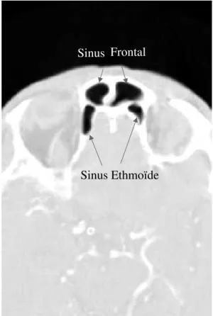 Fig. 1.7 : Exemple de clich´e TDM axial acquis au niveau du sinus frontal.