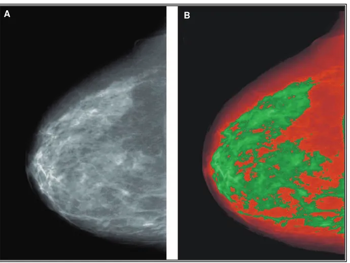 Figure 5 : Image mammaire telle que visualisée à la mammographie (A) et par le programme Cumulus 