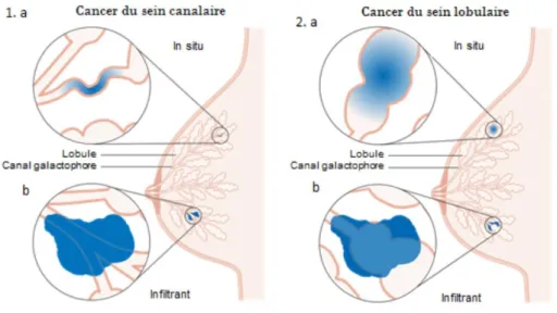 Figure 4 - Localisation de la tumeur selon le type de cancer du sein – 1. canalaire ou 2