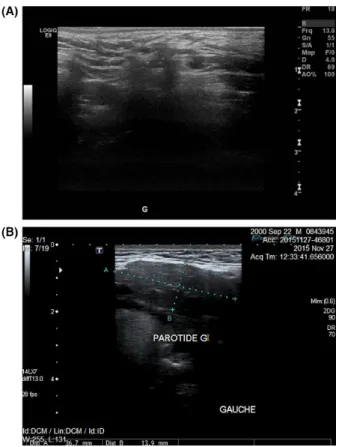 Figure 4. Ultrasonography demonstrating the hypoplastic left submandibular gland in the presented case (A) compared to the ultrasonography of the left submandibular gland in a healthy  16-year-old male (B).