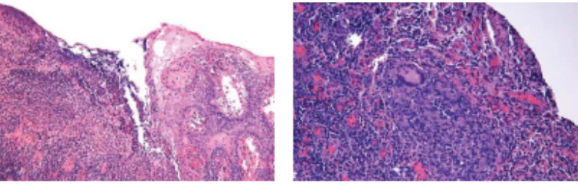 Figure 6 : Celles géantes et granulomes présents dans la muqueuse d’un patient  atteint de la maladie de Crohn