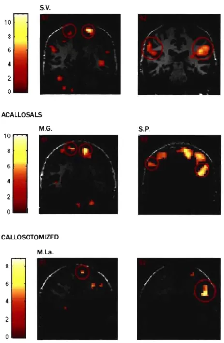 Fig.  J  Individual  t-maps  of brain  activation  overlaid  on  anatomical  images  showing  responses  in  SI  and  S2  (red  circles) during  tactile  stimulation  of the  left  leg