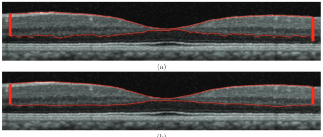 Figure 2.6 – Eﬀet de régularisation par contour actif pour la segmentation de l’interface OPL/ONL