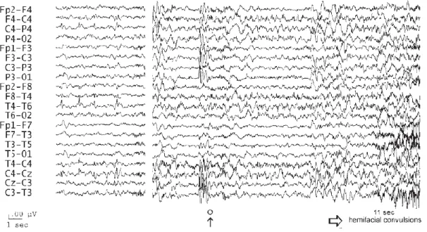 Figure  7.  Exemple  d’un  tracé  électroencéphalographique  ictal  typique  d’une  épilepsie BECTS (Panayiotopoulos et al., 2008)
