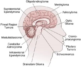 Figure 2. Brain cancer histology by location in the brain 1 